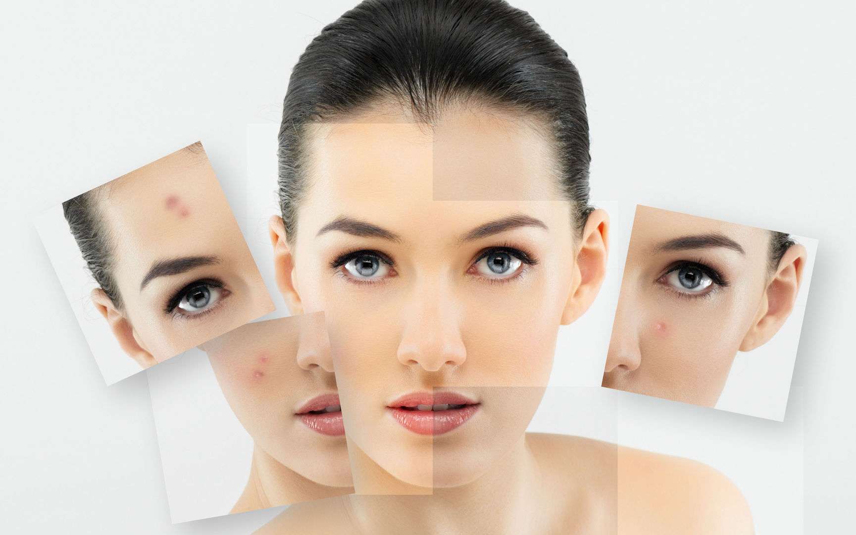 Здоров'я шкіри - як прищі призводять до появи шрамів